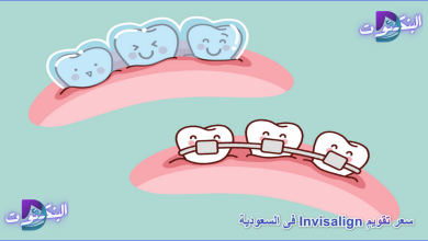 سعر تقويم Invisalign فى السعودية